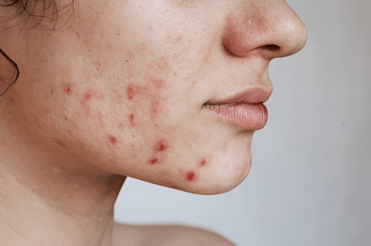 Acne Solutions Sunsuria Medical Clinic - Affordable Clinic for Health Screening & X-ray in Sepang, Nilai