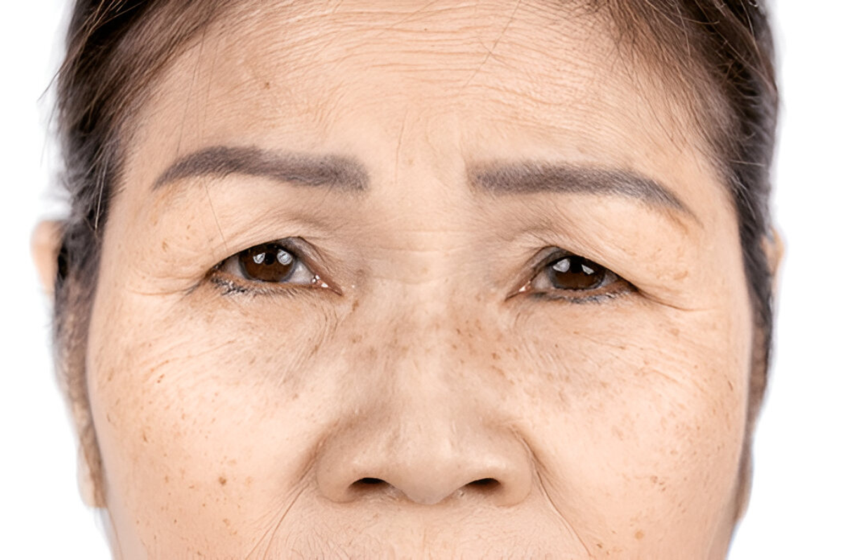 Fine Lines & Wrinkles' Sunsuria Medical Clinic - Affordable Clinic for Health Screening & X-ray in Sepang, Nilai