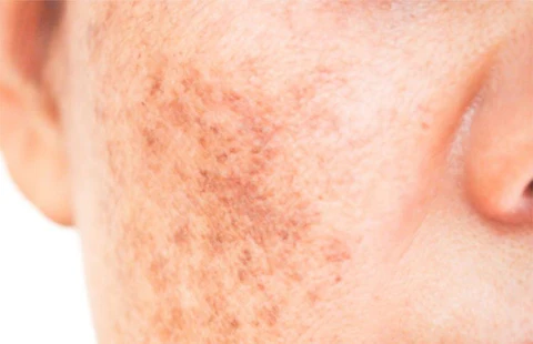 Hyperpigmentation & Sunspots Sunsuria Medical Clinic - Affordable Clinic for Health Screening & X-ray in Sepang, Nilai